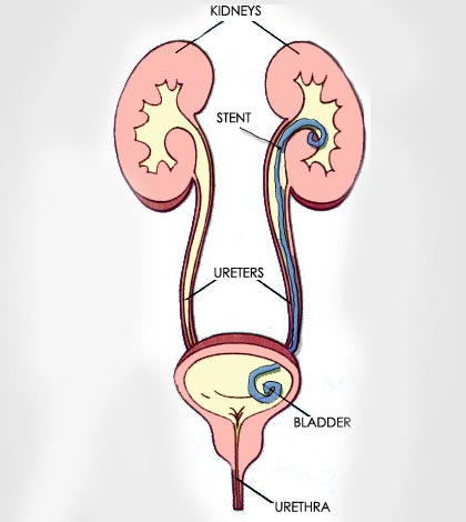 Nephroureteral Stent